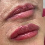 labios relleno natural estetica en beauty leganes leganes