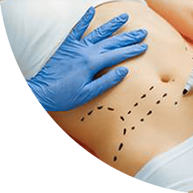 marcacion preoperatoria modelado corporal en beauty leganes leganes